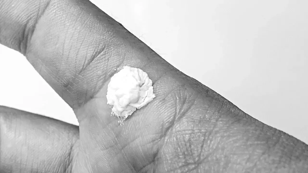 Un rimedio della nonna per le verruche: una pasta bianca applicata su una verruca sul dorso di una mano.